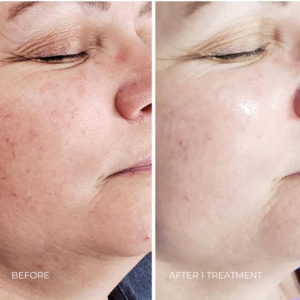 Procell Before & After on Face